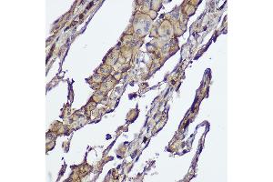 Immunohistochemistry of paraffin-embedded human lung cancer using /2 Rabbit mAb (ABIN1679270, ABIN1679271, ABIN7101491 and ABIN7101492) at dilution of 1:100 (40x lens). (AKT1/2 抗体)