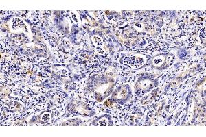 Detection of GCSFR in Human Stomach cancer Tissue using Polyclonal Antibody to Colony Stimulating Factor Receptor, Granulocyte (GCSFR) (CSF3R 抗体  (AA 271-428))