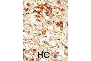 Formalin-fixed and paraffin-embedded human hepatocellular carcinoma tissue reacted with PCTK2 polyclonal antibody  , which was peroxidase-conjugated to the secondary antibody, followed by DAB staining. (CDK17 抗体  (N-Term))