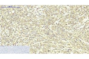 Immunohistochemistry of paraffin-embedded Human breast cancer tissue using ABCB5 Monoclonal Antibody at dilution of 1:200. (ABCB5 抗体)