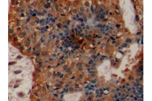 Detection of EGFR in Human Breast cancer Tissue using Polyclonal Antibody to Epidermal Growth Factor Receptor (EGFR) (EGFR 抗体  (AA 888-1210))