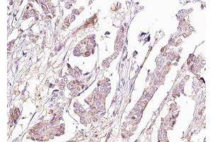 ABIN6267680 at 1/100 staining human Breast carcinoma tissue sections by IHC-P. (BAD 抗体  (pSer155))