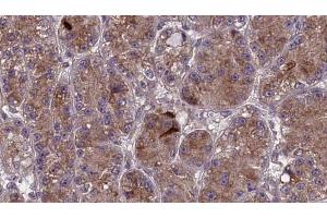 ABIN6273984 at 1/100 staining Human liver cancer tissue by IHC-P. (OR2V1 抗体  (Internal Region))