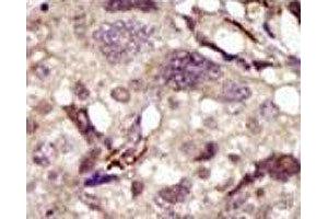 IHC analysis of FFPE human breast carcinoma tissue stained with the BTK antibody (BTK 抗体  (AA 209-239))