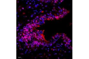 Immunofluorescence of paraffin embedded human breast cancer using SUV39H1 (ABIN7075770) at dilution of 1:1000 (400x lens) (SUV39H1 抗体)