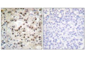 Immunohistochemistry analysis of paraffin-embedded human breast carcinoma tissue using USF2 antibody. (USF2 抗体  (Internal Region))