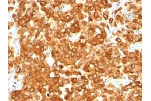 IHC staining of human melanoma with gp100 antibody (HMB45). (Melanoma gp100 抗体)