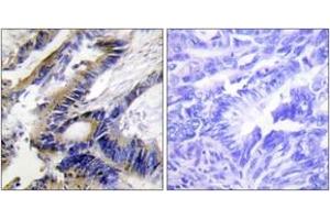 Immunohistochemistry analysis of paraffin-embedded human colon carcinoma tissue, using ILKAP Antibody. (ILKAP 抗体  (AA 41-90))