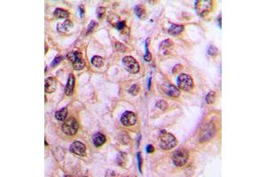 Immunohistochemical analysis of MST1/2 (pT183) staining in human breast cancer formalin fixed paraffin embedded tissue section. (MST1/MST2 (pSer183) 抗体)