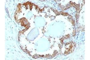 IHC testing of FFPE human prostate carcinoma and HSP27 antibody. (HSP27 抗体)