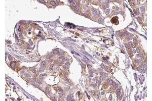 ABIN6267685 at 1/100 staining human Breast cancer tissue sections by IHC-P. (ASK1 抗体  (pSer83))