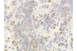 ABIN6256779 and ABIN6267619 at 1/100 staining human melanoma by IHC-P.