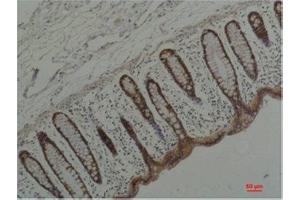 Immunohistochemistry (IHC) analysis of paraffin-embedded Human Colon Carcicnoma using HSP90 alpha Mouse Monoclonal Antibody diluted at 1:200. (HSP90AA2 抗体)