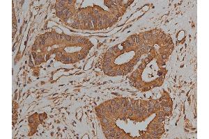 ABIN6269036 at 1/50 staining human colon cancer tissue sections by IHC-P.