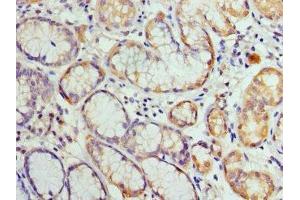 Immunohistochemistry of paraffin-embedded human gastric cancer using ABIN7155429 at dilution of 1: 100 (HIST2H3A 抗体  (AA 108-136))