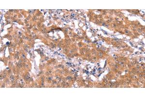 Immunohistochemistry of paraffin-embedded Human gastric cancer tissue using FAM13B Polyclonal Antibody at dilution 1:30 (FAM13B 抗体)