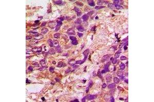 Immunohistochemical analysis of Aconitase 1 staining in human prostate cancer formalin fixed paraffin embedded tissue section. (Aconitase 1 抗体  (N-Term))