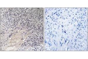 Immunohistochemistry analysis of paraffin-embedded human cervix carcinoma tissue, using ARHGDIA (Ab-174) Antibody. (ARHGDIA 抗体  (AA 140-189))