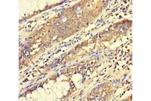 Immunohistochemistry of paraffin-embedded human colon cancer using ABIN7165014 at dilution of 1:100