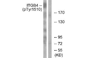 Immunohistochemistry analysis of paraffin-embedded human breast carcinoma tissue using ITGB4 (Phospho-Tyr1510) antibody. (Integrin beta 4 抗体  (pTyr1510))