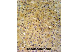 NDUFA10 Antibody IHC analysis in formalin fixed and paraffin embedded hepatocarcinoma followed by peroxidase conjugation of the secondary antibody and DAB staining. (NDUFA10 抗体  (AA 252-281))