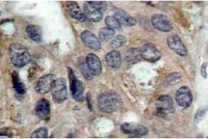 Immunohistochemistry (IHC) analyzes of p-c-Src antibody in paraffin-embedded human breast carcinoma tissue. (NCOA1 抗体  (pTyr529))