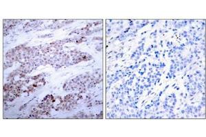 Immunohistochemical analysis of paraffin-embedded human breast carcinoma tissue using ATF4(Phospho-Ser245) Antibody(left) or the same antibody preincubated with blocking peptide(right). (ATF4 抗体  (pSer245))