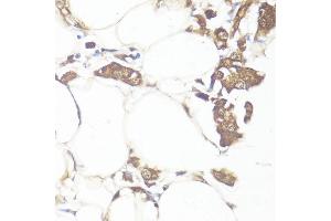 Immunohistochemistry of paraffin-embedded human breast cancer using Smad7 antibody (ABIN7270356) at dilution of 1:100 (40x lens). (SMAD7 抗体  (AA 1-100))