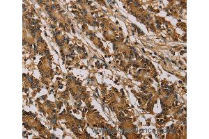 Immunohistochemistry of Human colon cancer using PSMC2 Polyclonal Antibody at dilution of 1:30 (PSMC2 抗体)