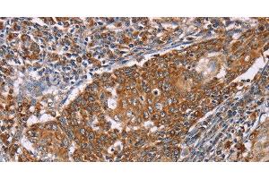 Immunohistochemistry of paraffin-embedded Human cervical cancer tissue using PMPCB Polyclonal Antibody at dilution 1:50 (PMPCB 抗体)