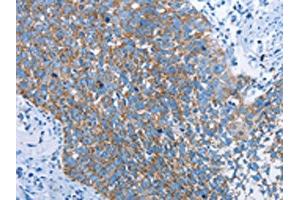 The image on the left is immunohistochemistry of paraffin-embedded Human cervical cancer tissue using ABIN7129698(HINT2 Antibody) at dilution 1/40, on the right is treated with fusion protein. (HINT2 抗体)