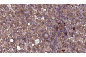 ABIN6276788 at 1/100 staining Human liver cancer tissue by IHC-P. (ITGAL 抗体  (N-Term))