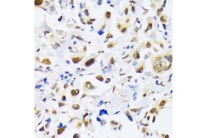 Immunohistochemistry of paraffin-embedded human lung cancer using EP300 antibody (ABIN6127823, ABIN6140193, ABIN6140194 and ABIN6216844) at dilution of 1:100 (40x lens). (p300 抗体  (AA 1-270))