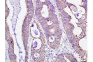 Paraformaldehyde-fixed, paraffin embedded human colon cancer, Antigen retrieval by boiling in sodium citrate buffer (pH6) for 15min, Block endogenous peroxidase by 3% hydrogen peroxide for 30 minutes, Blocking buffer (normal goat serum) at 37°C for 20min, Antibody incubation with GRP75 Polyclonal Antibody, Unconjugated  at 1:500 overnight at 4°C, followed by a conjugated secondary and DAB staining. (HSPA9 抗体  (AA 561-679))