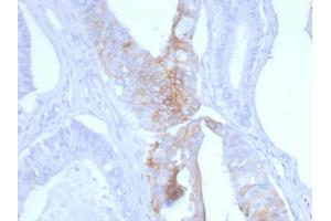 Formalin-fixed, paraffin-embedded human Colon Carcinoma stained with Cytokeratin 20 Mouse Monoclonal Antibody (KRT20/3145). (KRT20 抗体  (AA 196-323))