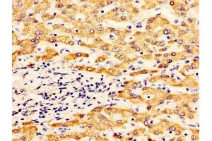 IHC image of ABIN7170921 diluted at 1:400 and staining in paraffin-embedded human liver cancer performed on a Leica BondTM system. (ALDH5A1 抗体  (AA 48-535))