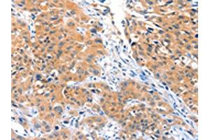 The image on the left is immunohistochemistry of paraffin-embedded Human lung cancer tissue using ABIN7128174(ACOX3 Antibody) at dilution 1/25, on the right is treated with fusion protein. (ACOX3 抗体)