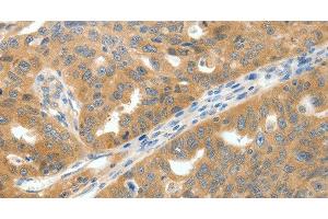 Immunohistochemistry of paraffin-embedded Human ovarian cancer tissue using SCN9A Polyclonal Antibody at dilution 1:40 (SCN9A 抗体)