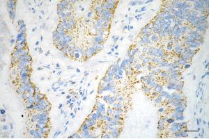 Immunohistochemistry was performed on paraffin-embedded human sigmoid colon carcinoma using COX IV antibody (ABIN7798247), 1:200). (Recombinant COX IV 抗体)