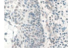 IHC-P analysis of Human Skin Cancer Tissue, with DAB staining. (COQ6 抗体  (AA 1-468))