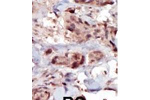 Formalin-fixed and paraffin-embedded human cancer tissue reacted with the primary antibody, which was peroxidase-conjugated to the secondary antibody, followed by AEC staining. (SPHK2 抗体  (C-Term))