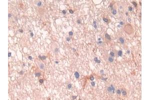DAB staining on IHC-P; Samples: Human Glioma Tissue (PTH1R 抗体  (AA 28-188))