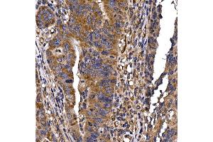 Immunohistochemistry of paraffin-embedded human colon carcinoma using DYNC1LI2 Rabbit pAb (ABIN7266863) at dilution of 1:25 (40x lens). (DYNC1LI2 抗体)