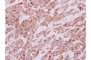 IHC-P Image IDH3G antibody detects IDH3G protein at cytoplasm on human lung carcinoma by immunohistochemical analysis. (IDH3G 抗体)