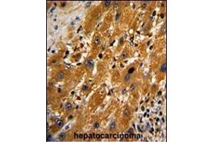 Formalin-fixed and paraffin-embedded human hepatocarcinoma with CASP9 Antibody , which was peroxidase-conjugated to the secondary antibody, followed by DAB staining. (Caspase 9 抗体  (Ser196))