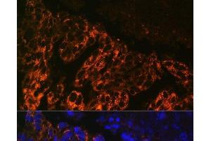 Immunofluorescence analysis of Human lung cancer cells using SCNN1A Polyclonal Antibody at dilution of 1:100. (SCNN1A 抗体)