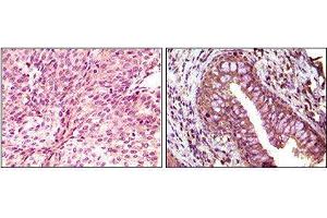 Immunohistochemical analysis of paraffin-embedded human bladder carcinoma (left) and return carcinoma (right) tissue, showing cytoplasmic localization using EphB6 mouse mAb with DAB staining. (EPH Receptor B6 抗体)