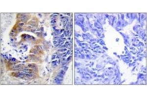 Immunohistochemistry analysis of paraffin-embedded human colon carcinoma tissue, using CDCA3 Antibody. (CDCA3 抗体  (AA 219-268))