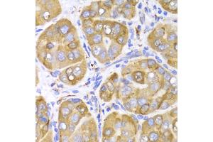 Immunohistochemistry of paraffin-embedded human liver cancer using LRPAP1 Antibody (ABIN5971543) at dilution of 1/100 (40x lens). (LRPAP1 抗体)