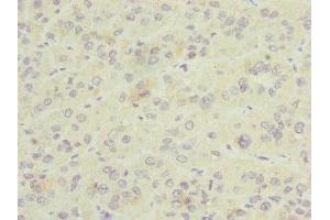 Immunohistochemistry of paraffin-embedded human liver cancer using ABIN7153581 at dilution of 1:100 (GDAP1 抗体  (AA 1-225))